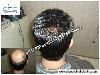 Photo of PHC-The Planet Of Hair Cloning Malviya Nagar Delhi