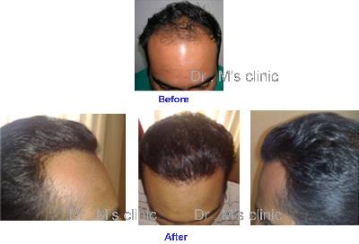 Dr M's Hair Transplant Clinic in Paldi, Ahmedabad - AskLaila