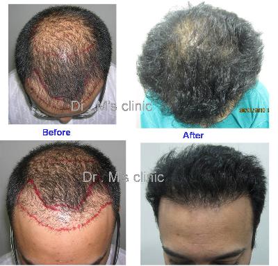 Hair Clinic Ahmedabad Dr Ms Hair Transplant Clinic 1289899961811 regular